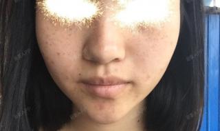 医院点斑多少钱 医院点斑多少钱